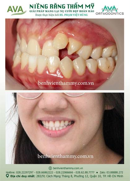 Hình ảnh trước và sau khi niềng răng – niềng răng trả góp quận 10 tại Nha khoa AVA, ca 141