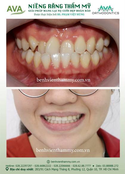 Kết quả niềng răng TPHCM trước và sau tại Nha khoa AVA Quận 10, ca 142