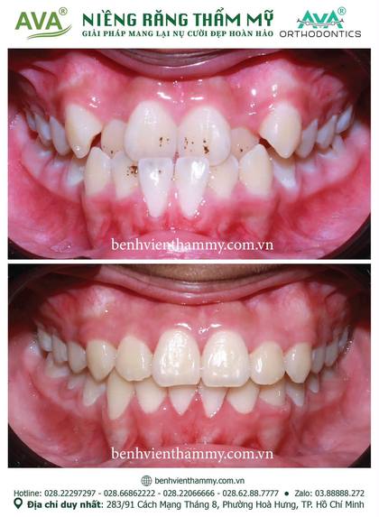 Hình ảnh trước và sau khi niềng răng – niềng răng trả góp quận 10 tại Nha khoa AVA, ca 144