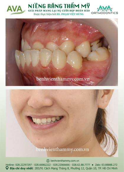 Hình ảnh trước và sau khi niềng răng – niềng răng trả góp quận 10 tại Nha khoa AVA, ca 15