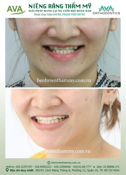 Kết quả niềng răng TPHCM trước và sau tại Nha khoa AVA Quận 10, ca 16