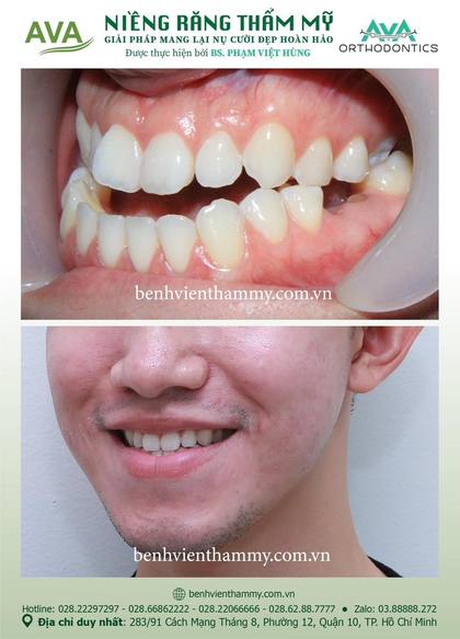 Ca niềng răng trả góp tphcm trước và sau điều trị tại Nha khoa AVA, ca 17