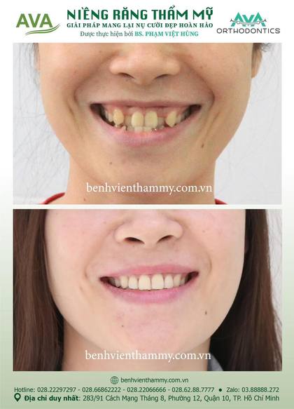Hình ảnh trước và sau khi niềng răng – niềng răng trả góp quận 10 tại Nha khoa AVA, ca 18