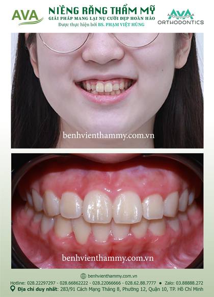 Kết quả niềng răng TPHCM trước và sau tại Nha khoa AVA Quận 10, ca 19