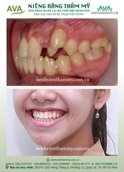 Ca niềng răng trả góp tphcm trước và sau điều trị tại Nha khoa AVA, ca 02