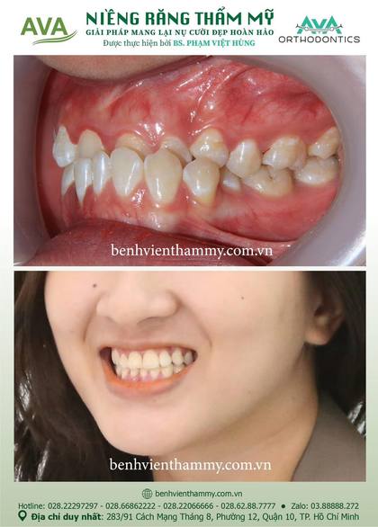 Hình ảnh trước và sau khi niềng răng – niềng răng trả góp quận 10 tại Nha khoa AVA, ca 21