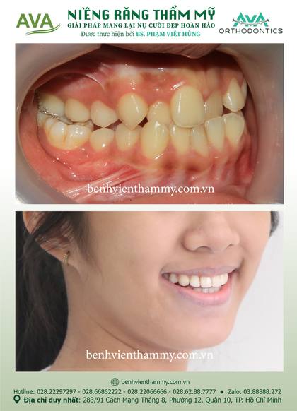 Kết quả niềng răng TPHCM trước và sau tại Nha khoa AVA Quận 10, ca 22