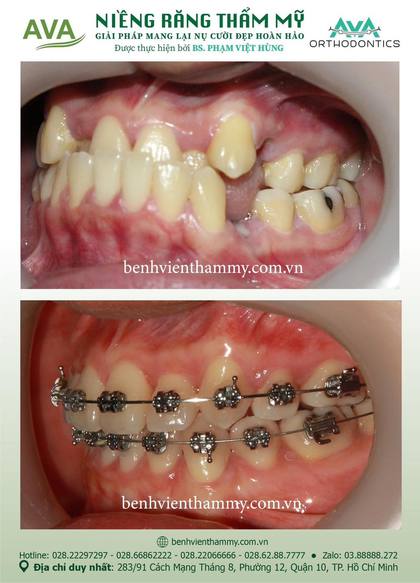 Mắc cài hay Invisalign? – Nha khoa AVA Quận 10