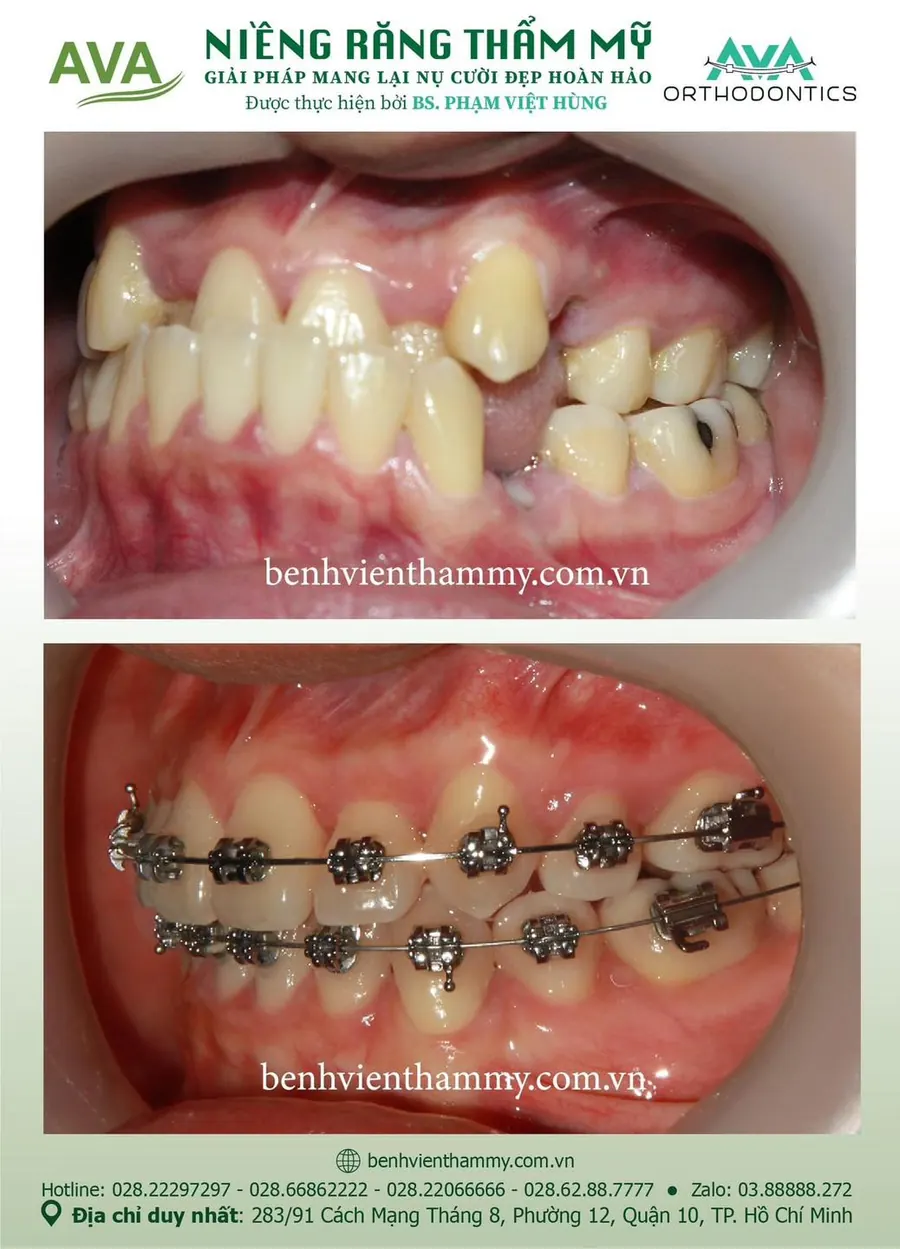 Một ca niềng răng thực tế trước và sau tại Nha khoa AVA, Quận 10, TPHCM