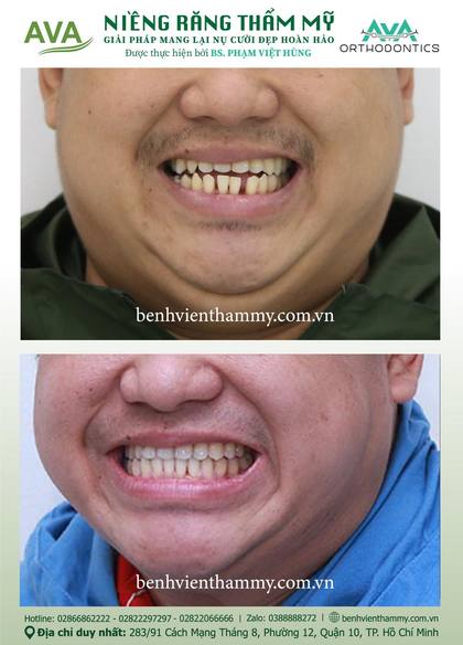 Kết quả niềng răng TPHCM trước và sau tại Nha khoa AVA Quận 10, ca 25