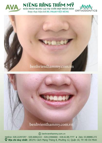 Ca niềng răng trả góp tphcm trước và sau điều trị tại Nha khoa AVA, ca 26