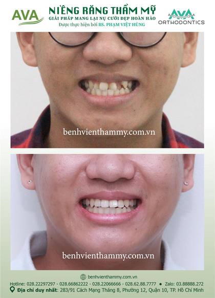 Hình ảnh trước và sau khi niềng răng – niềng răng trả góp quận 10 tại Nha khoa AVA, ca 27