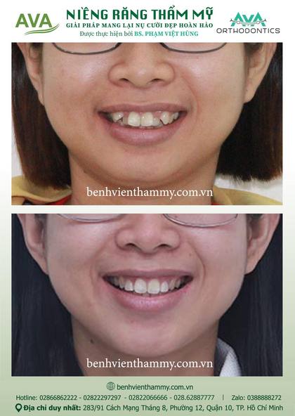 Kết quả niềng răng TPHCM trước và sau tại Nha khoa AVA Quận 10, ca 28