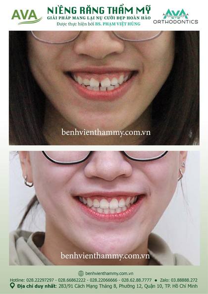 Ca niềng răng trả góp tphcm trước và sau điều trị tại Nha khoa AVA, ca 29