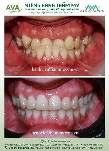 Hình ảnh trước và sau khi niềng răng – niềng răng trả góp quận 10 tại Nha khoa AVA, ca 03