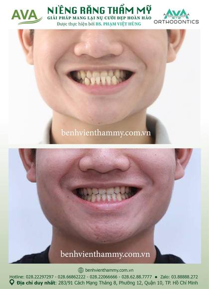 Ca niềng răng trả góp tphcm trước và sau điều trị tại Nha khoa AVA, ca 32
