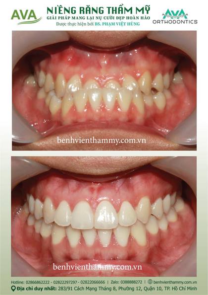 Hình ảnh trước và sau khi niềng răng – niềng răng trả góp quận 10 tại Nha khoa AVA, ca 33
