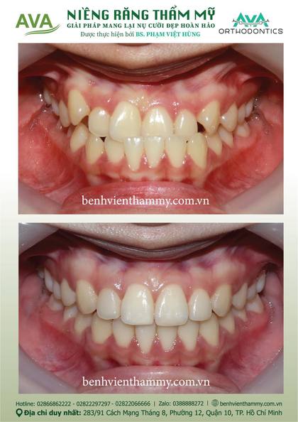 Kết quả niềng răng TPHCM trước và sau tại Nha khoa AVA Quận 10, ca 34