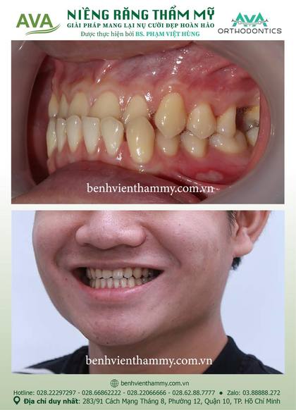Kết quả niềng răng TPHCM trước và sau tại Nha khoa AVA Quận 10, ca 37