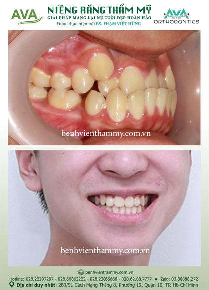 Ca niềng răng trả góp tphcm trước và sau điều trị tại Nha khoa AVA, ca 38