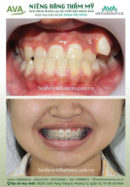 Hình ảnh trước và sau khi niềng răng – niềng răng trả góp quận 10 tại Nha khoa AVA, ca 39