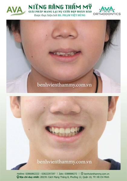 Kết quả niềng răng TPHCM trước và sau tại Nha khoa AVA Quận 10, ca 40