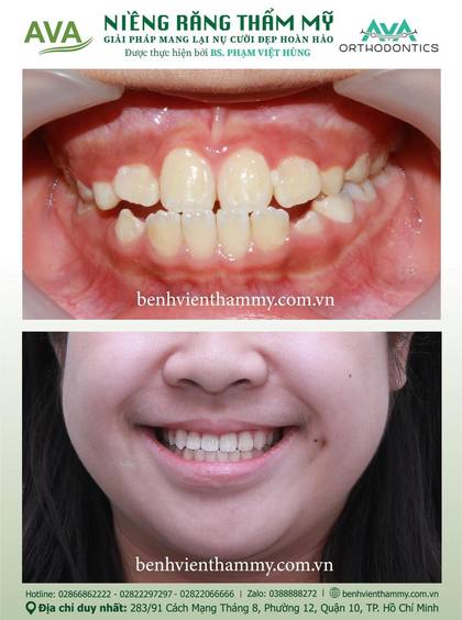 Ca niềng răng trả góp tphcm trước và sau điều trị tại Nha khoa AVA, ca 41
