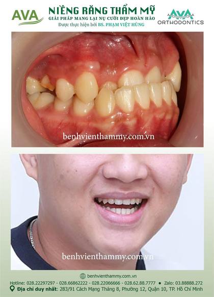 Hình ảnh trước và sau khi niềng răng – niềng răng trả góp quận 10 tại Nha khoa AVA, ca 42