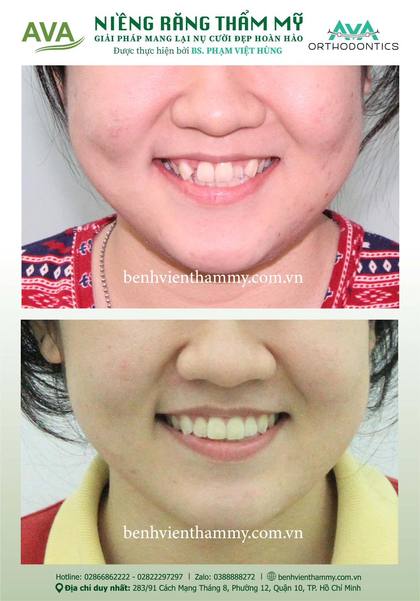 Ca niềng răng trả góp tphcm trước và sau điều trị tại Nha khoa AVA, ca 44