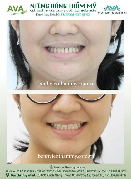 Hình ảnh trước và sau khi niềng răng – niềng răng trả góp quận 10 tại Nha khoa AVA, ca 45