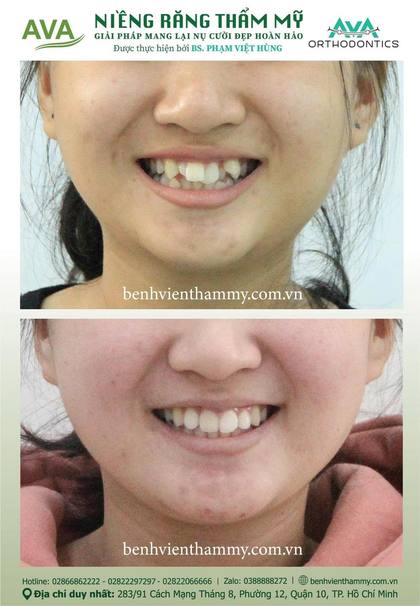 Kết quả niềng răng TPHCM trước và sau tại Nha khoa AVA Quận 10, ca 46