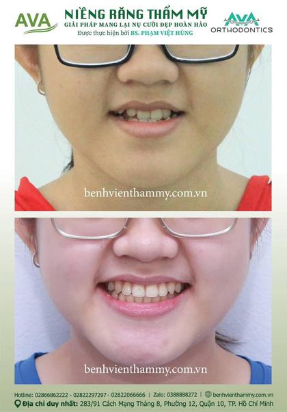 Ca niềng răng trả góp tphcm trước và sau điều trị tại Nha khoa AVA, ca 47