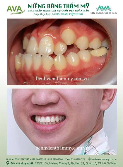 Hình ảnh trước và sau khi niềng răng – niềng răng trả góp quận 10 tại Nha khoa AVA, ca 48