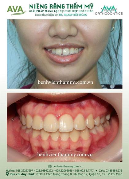 Kết quả niềng răng TPHCM trước và sau tại Nha khoa AVA Quận 10, ca 49