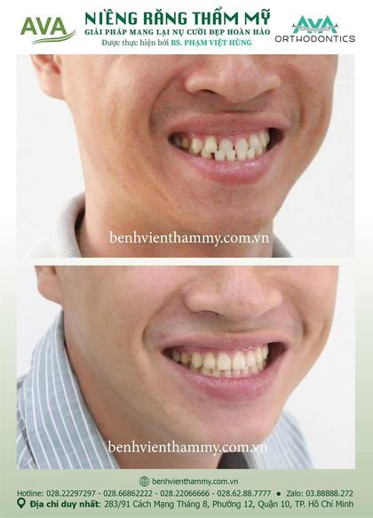 Ca niềng răng trả góp tphcm trước và sau điều trị tại Nha khoa AVA, ca 50