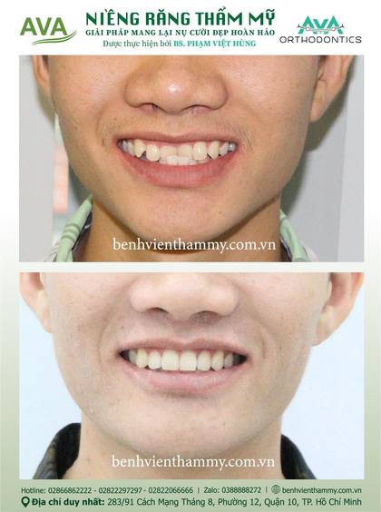 Hình ảnh trước và sau khi niềng răng – niềng răng trả góp quận 10 tại Nha khoa AVA, ca 51