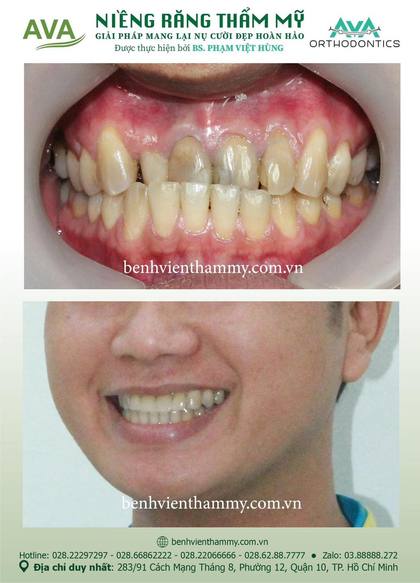 Kết quả niềng răng TPHCM trước và sau tại Nha khoa AVA Quận 10, ca 52