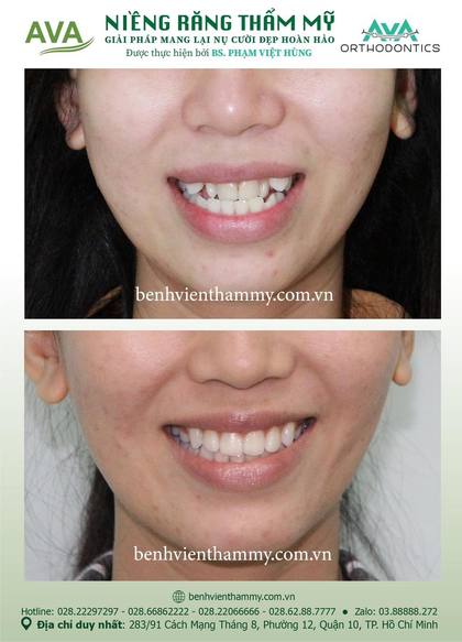 Ca niềng răng trả góp tphcm trước và sau điều trị tại Nha khoa AVA, ca 53