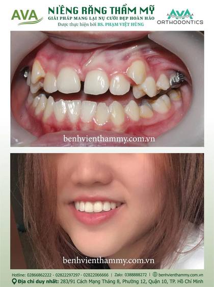Hình ảnh trước và sau khi niềng răng – niềng răng trả góp quận 10 tại Nha khoa AVA, ca 54