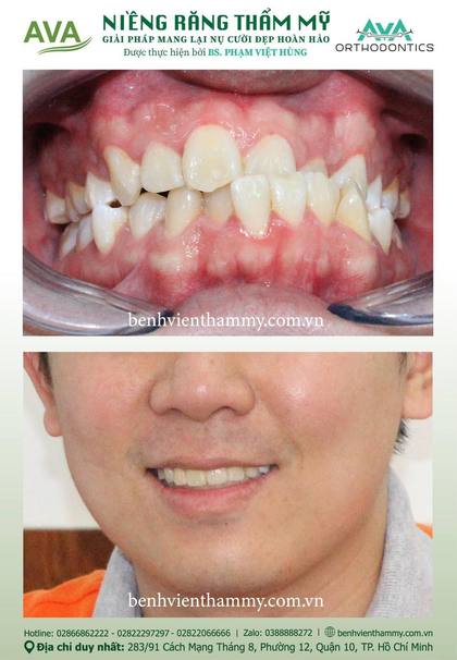 Kết quả niềng răng TPHCM trước và sau tại Nha khoa AVA Quận 10, ca 55