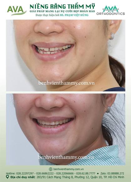 Ca niềng răng trả góp tphcm trước và sau điều trị tại Nha khoa AVA, ca 56