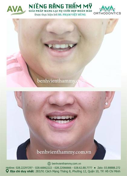 Kết quả niềng răng TPHCM trước và sau tại Nha khoa AVA Quận 10, ca 58