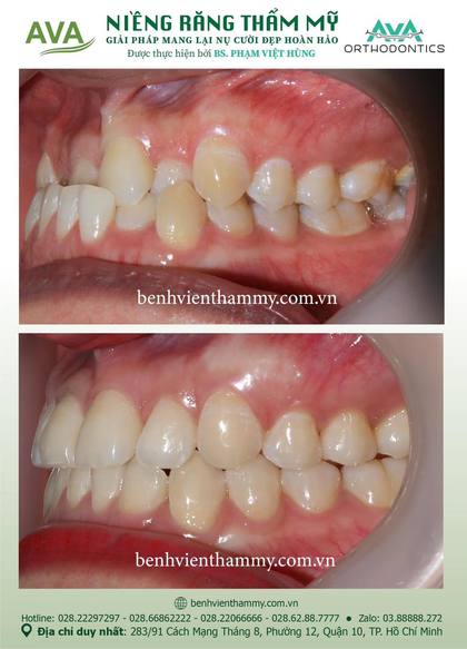 Ca niềng răng trả góp tphcm trước và sau điều trị tại Nha khoa AVA, ca 59