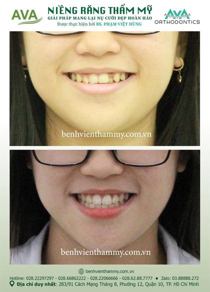 Hình ảnh trước và sau khi niềng răng – niềng răng trả góp quận 10 tại Nha khoa AVA, ca 60