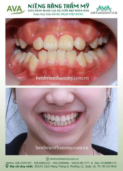 Kết quả niềng răng TPHCM trước và sau tại Nha khoa AVA Quận 10, ca 61