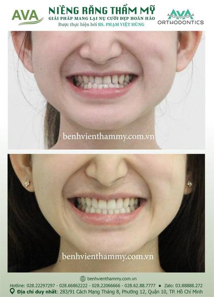 Ca niềng răng trả góp tphcm trước và sau điều trị tại Nha khoa AVA, ca 62