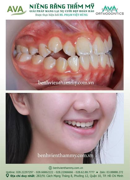 Hình ảnh trước và sau khi niềng răng – niềng răng trả góp quận 10 tại Nha khoa AVA, ca 63