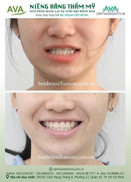 Kết quả niềng răng TPHCM trước và sau tại Nha khoa AVA Quận 10, ca 64