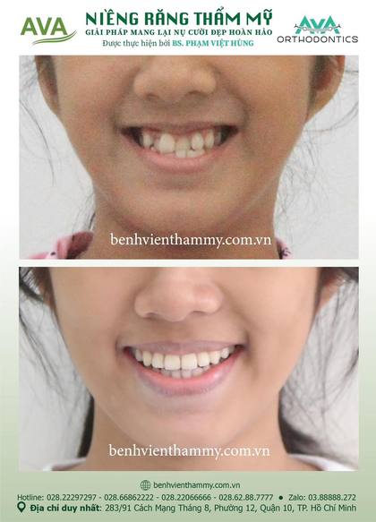 Hình ảnh trước và sau khi niềng răng – niềng răng trả góp quận 10 tại Nha khoa AVA, ca 66