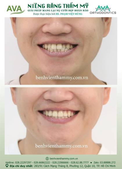 Kết quả niềng răng TPHCM trước và sau tại Nha khoa AVA Quận 10, ca 67